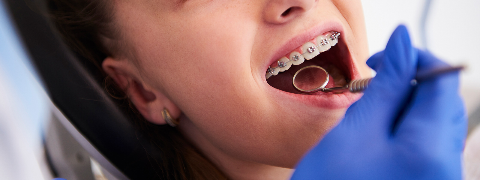 Different Types of Teeth Braces and their Uses